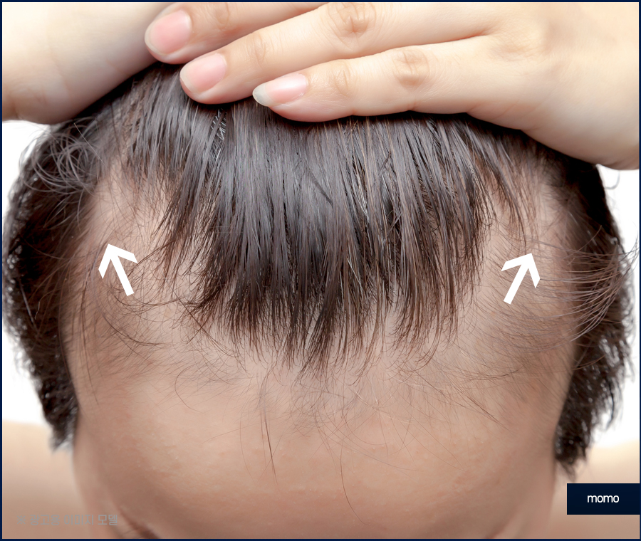 헤어라인 교정 비용 및 방법 디자인의 중요성 관련 이미지 11