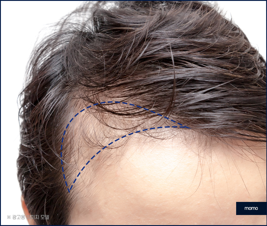 M자모발이식비용 가격 탈모 탈출을 위한 관련 이미지 11