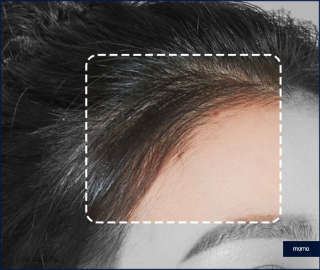 여성 모발이식 자연스러운 변화를 만드는 관련 이미지 2