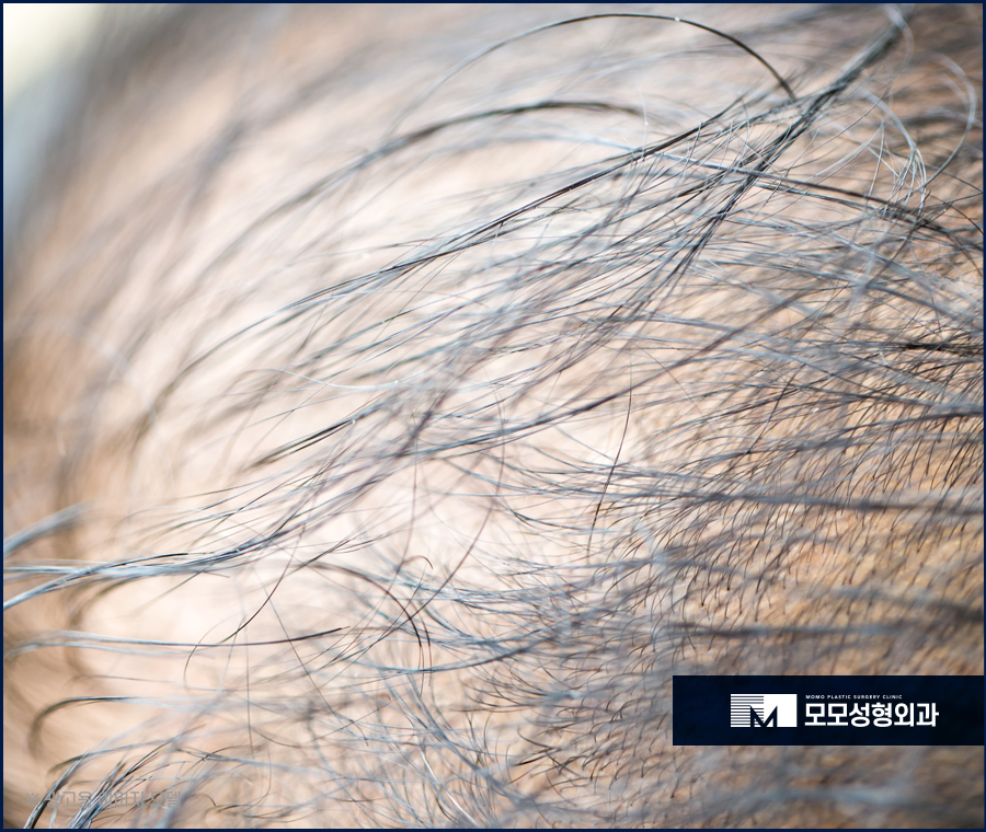 모발이식3000모비용 찾아 보는 것 보다 우선적인 것은 관련 이미지 4