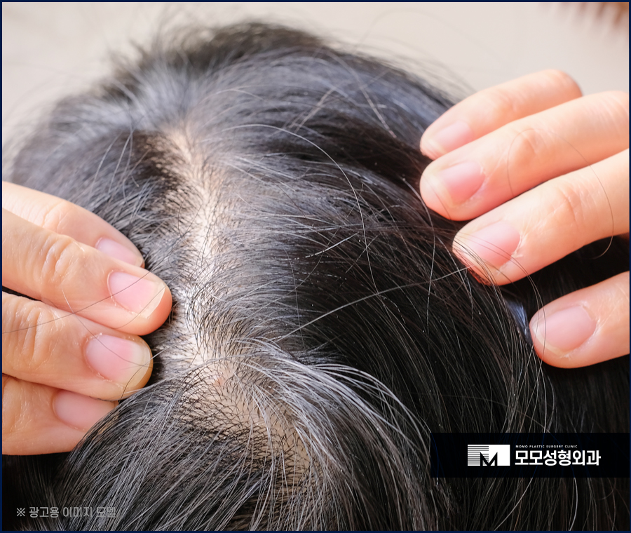 압구정모발이식 자연스러운 예후를 위한 선택 관련 이미지 2