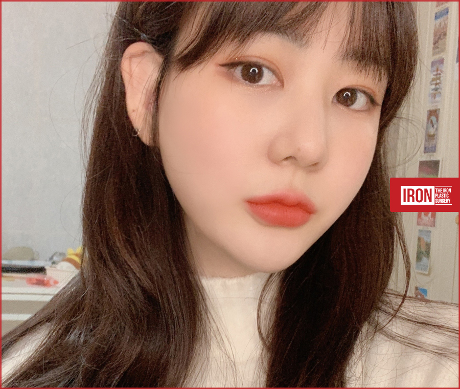 신사동 눈성형 똘망똘망한 눈매로 거듭나기 위해 관련 이미지 5