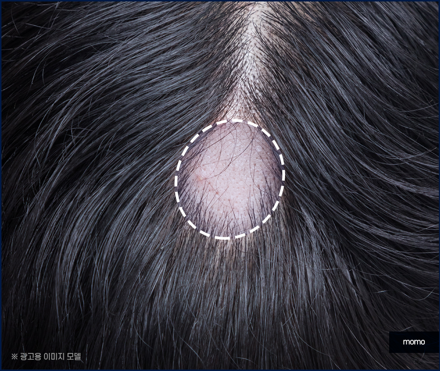 스트레스성 원형탈모를 유발하는 원인은 관련 이미지 4