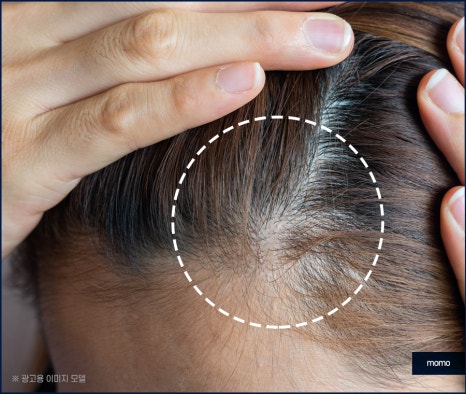 전두부탈모 원인과 시기, 해결 방안까지 관련 이미지 2