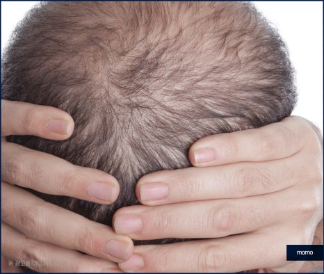 강남 모발이식 병원 차이가 나는 이유는 관련 이미지 9