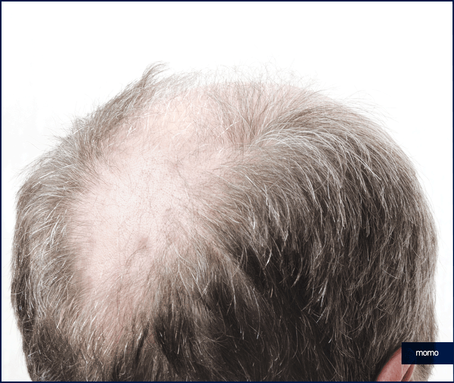 강남 모발이식 성공적인 변화를 만드는 꿀팁 관련 이미지 10