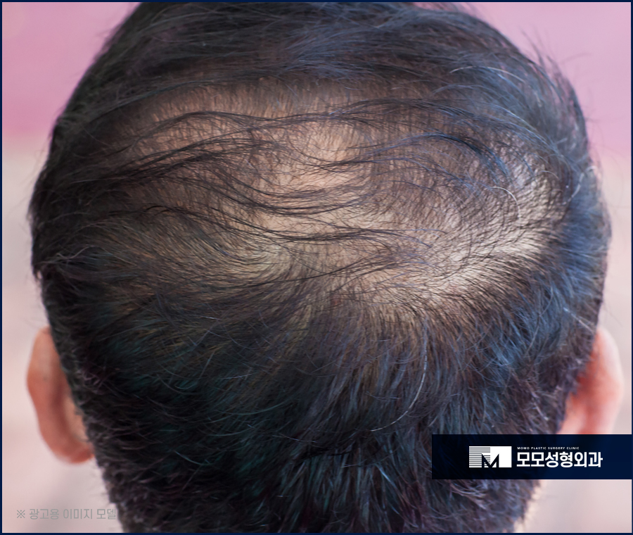 머리안감으면탈모 나타나게 될까 관련 이미지 7