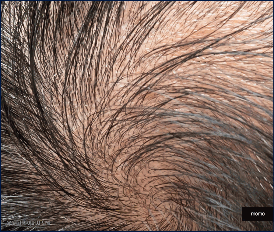 전두탈모 원인 보강을 위한 현명한 선택은? 관련 이미지 5