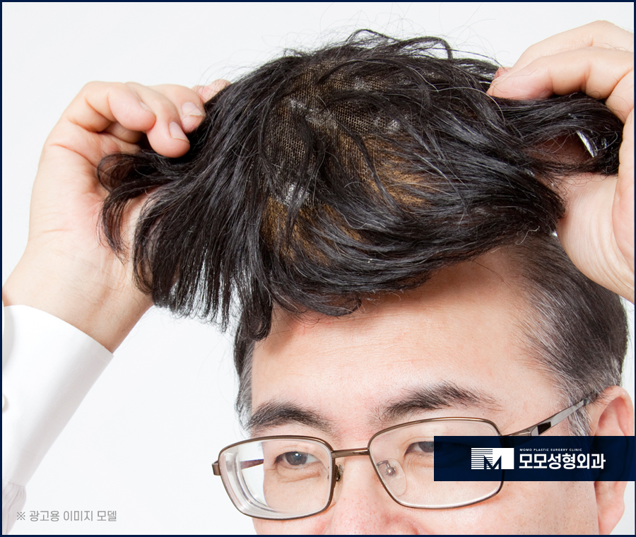 비절개모발이식비용 어느 정도 차이가 날까 관련 이미지 7