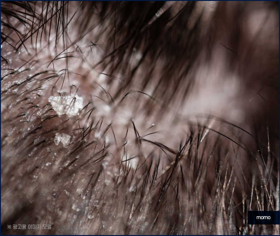 머리 비듬 생기는 이유부터 제거하는 효과적인 방법 관련 이미지 3