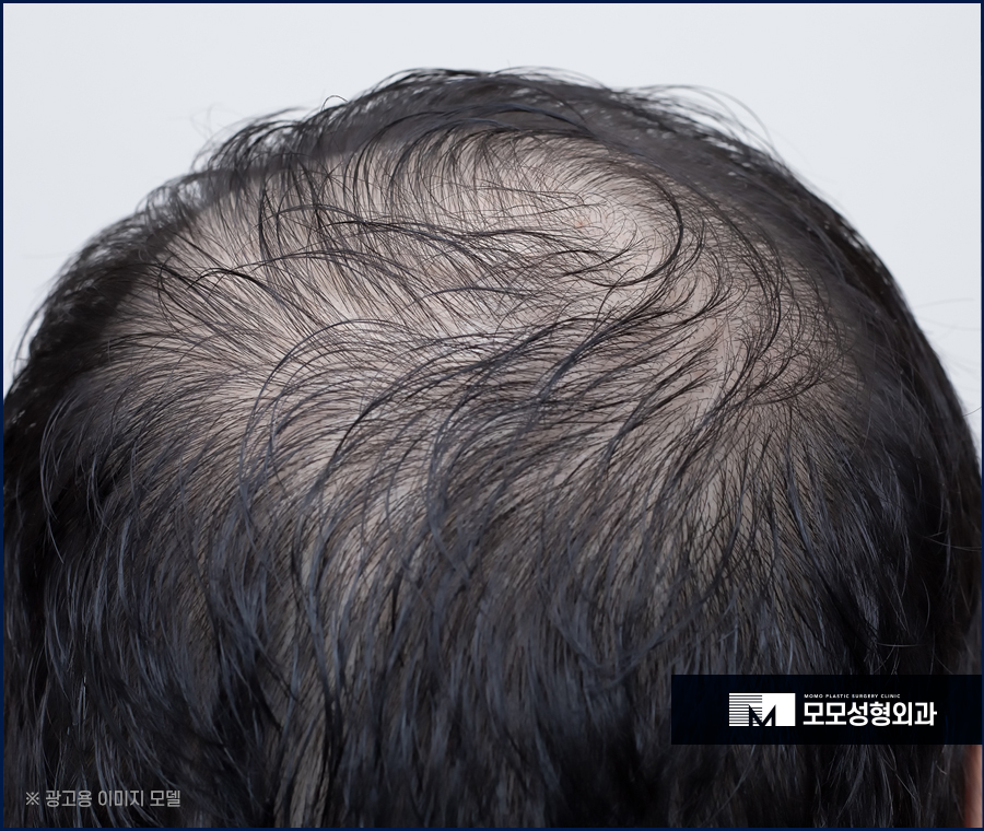 정수리탈모치료비용 모발이식을 기준으로 했을 땐 관련 이미지 3