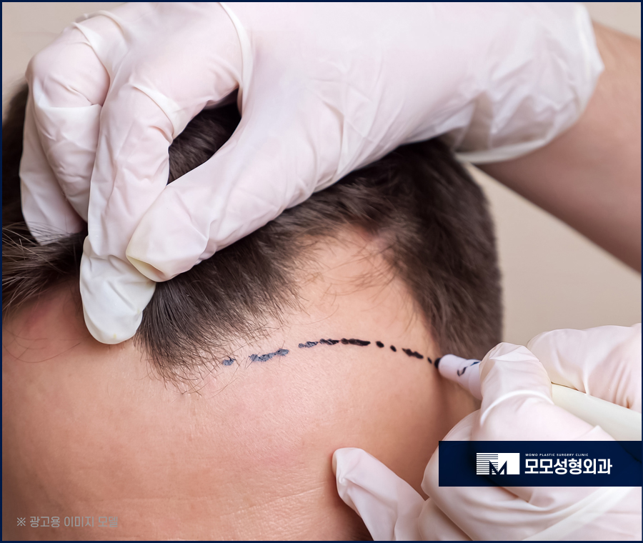 남자헤어라인모발이식 디자인까지 꼼꼼하게 고려하며 관련 이미지 4