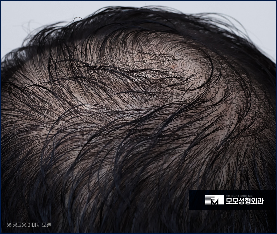 서울모발이식 고려하고 있다면 꼭 확인할 점은 관련 이미지 4