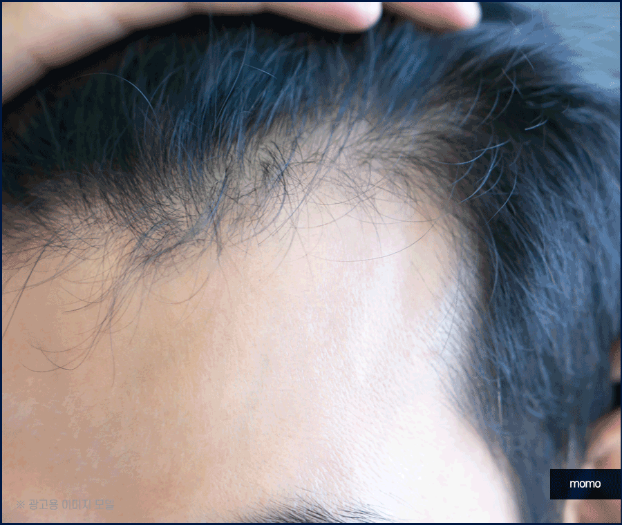 압구정 헤어라인 모발이식 라인 디자인으로 높인 완성도 관련 이미지 3