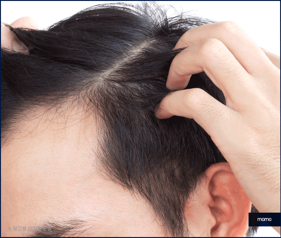 비절개 모발이식 후기와 함께 꼭 알아볼 이것! 관련 이미지 8