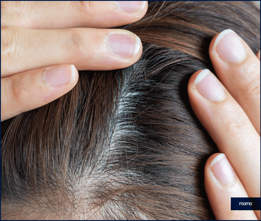 압구정 탈모병원 보완을 위한 최선책은? 관련 이미지 3