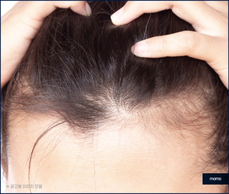 여자 m자 이마 헤어라인 모발이식으로 교정 관련 이미지 11