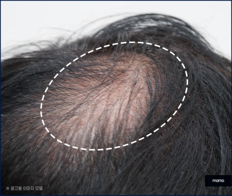 정수리 탈모 모발이식 섬세하게 채워가는 관련 이미지 5