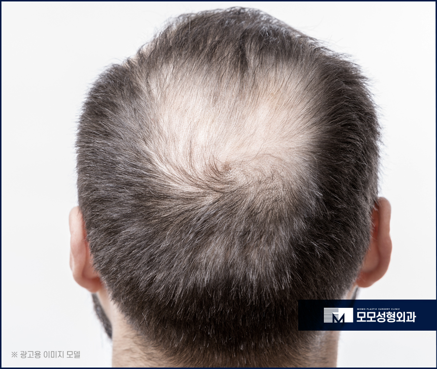 원형탈모 초기 타이밍을 놓치지 말고 대응해야 하는 이유 관련 이미지 6