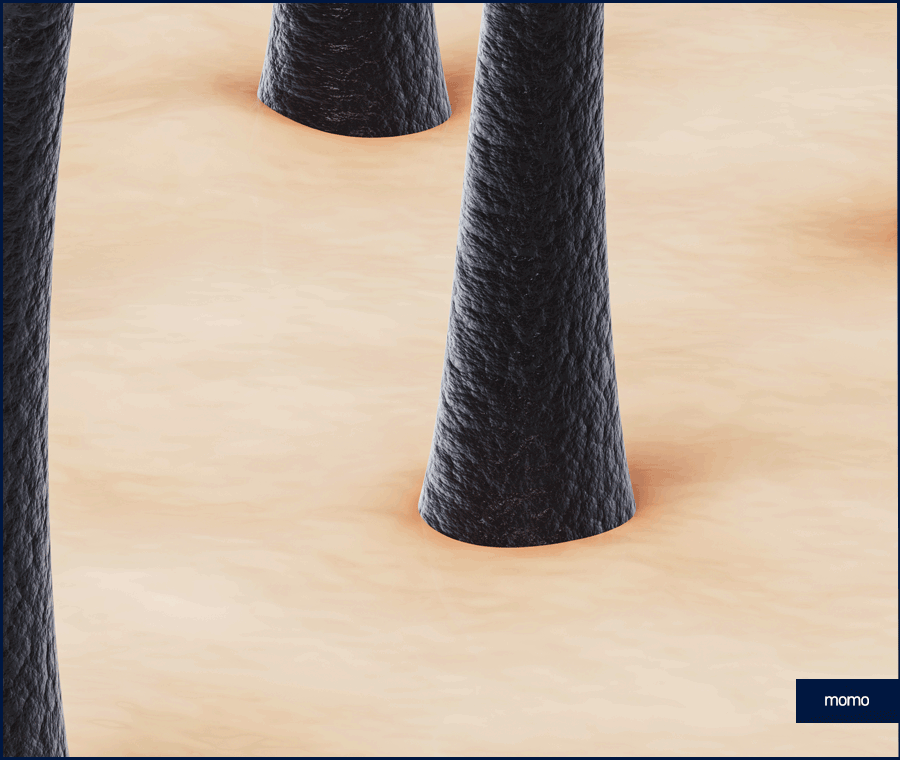 압구정 헤어라인 모발이식 라인 디자인으로 높인 완성도 관련 이미지 6