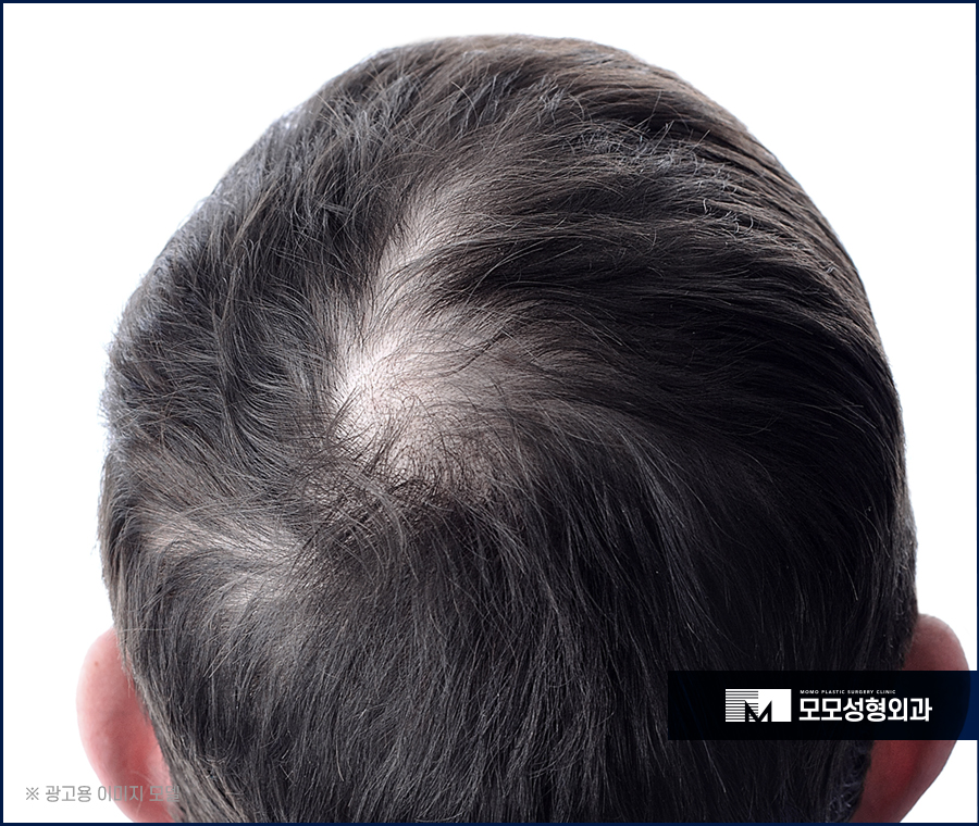 머리숱많아지는법 다양하게 알아보는 관련 이미지 2