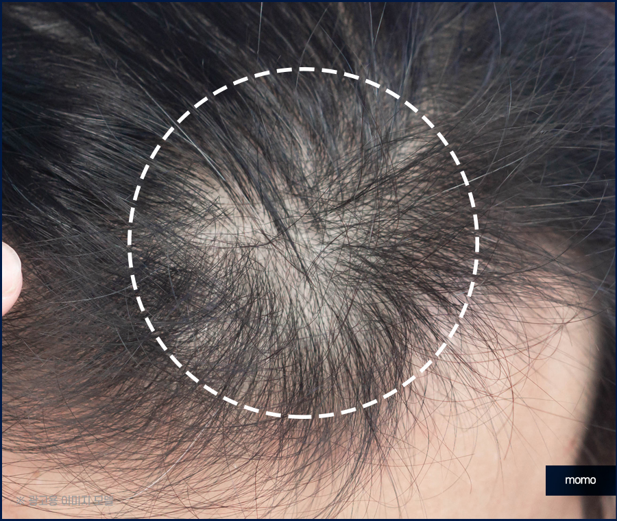 모발이식 생착률 기준짓는 요소들은 무엇일까 관련 이미지 9