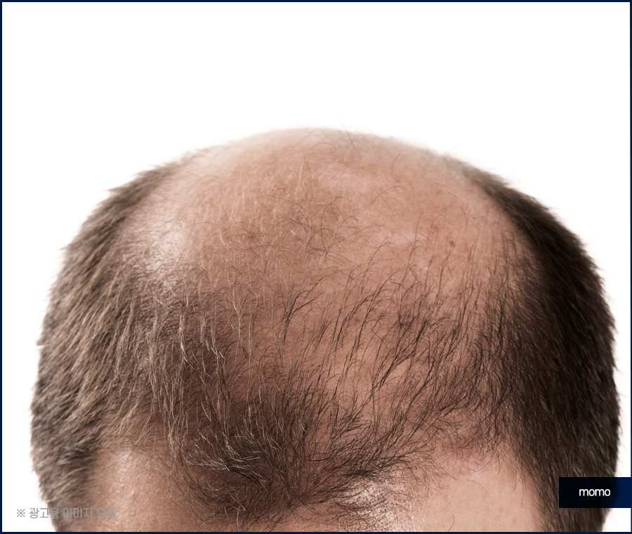 20대 원형탈모 효과적인 개선 방법은 관련 이미지 8