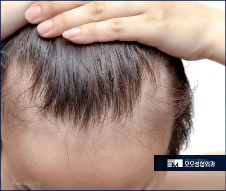남자머리심기 신속한 일상 회복을 위한 방법 (ft. 비절개모발이식) 관련 이미지 6