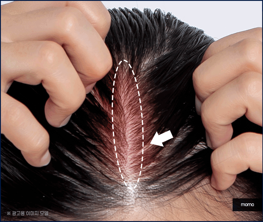 산후 탈모 언제까지 유지되는지 원인 및 대처법 관련 이미지 9