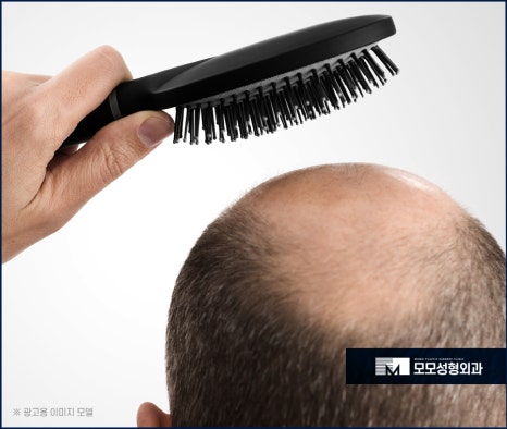 남자머리심기 신속한 일상 회복을 위한 방법 (ft. 비절개모발이식) 관련 이미지 5
