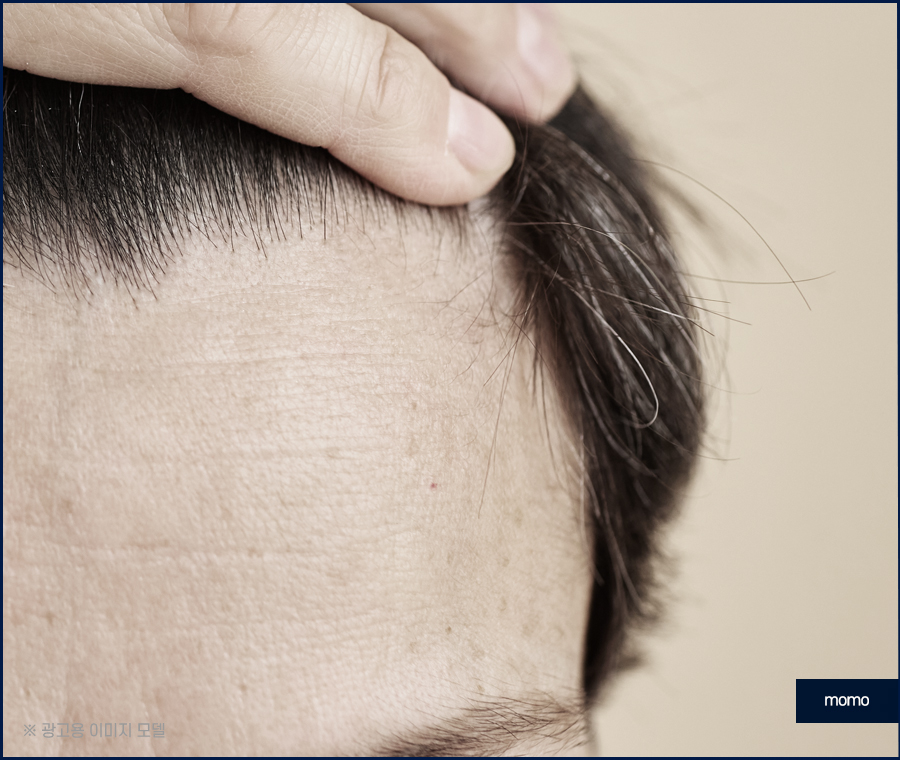 모발이식 생착기간 생착률 및 주의할 점 확인 관련 이미지 2