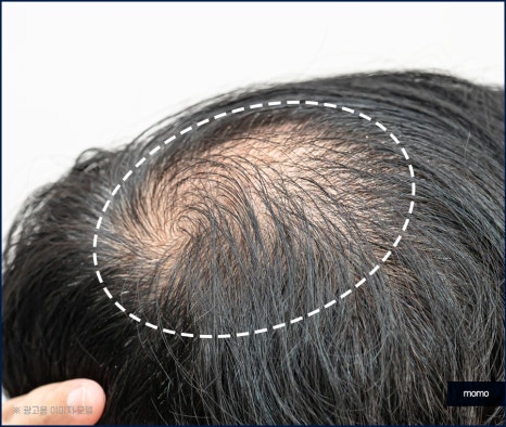정수리 탈모 모발이식 섬세하게 채워가는 관련 이미지 2