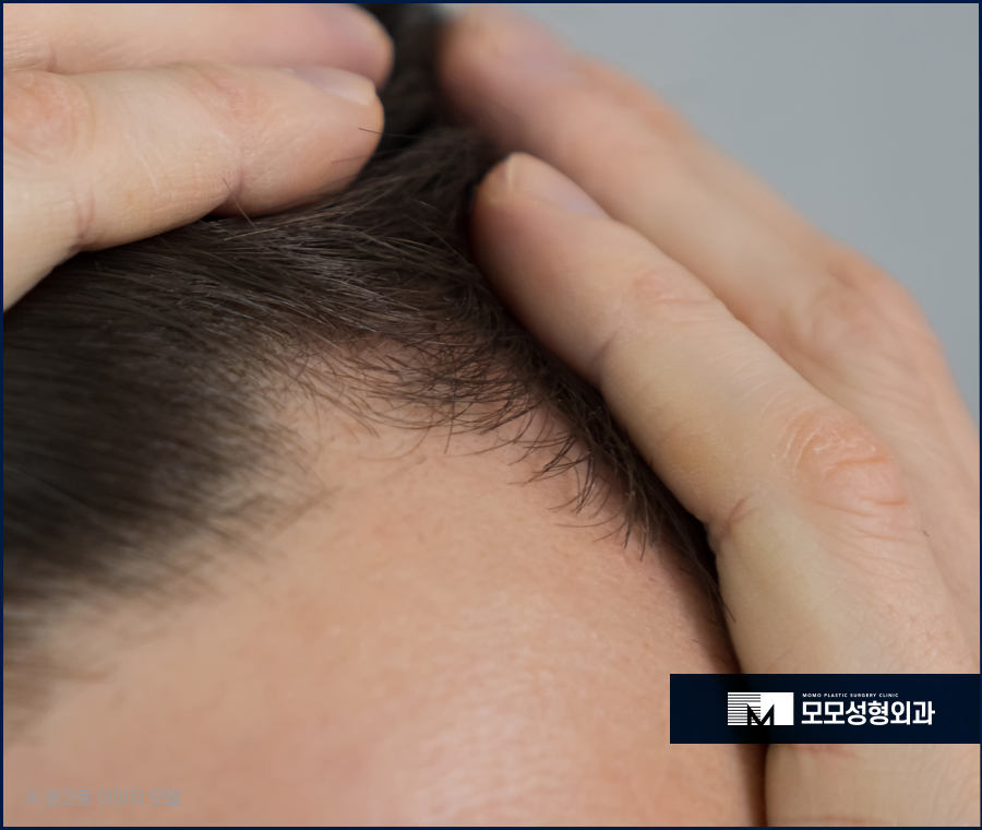 여성 헤어라인 모발이식 미모까지 완벽해 지는 효과 관련 이미지 8