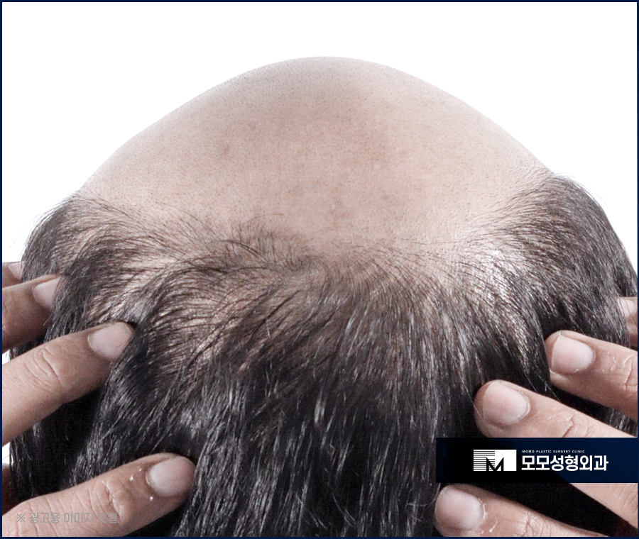 서울 모발이식 오랜 고민을 이겨내기 위한 선택 관련 이미지 4