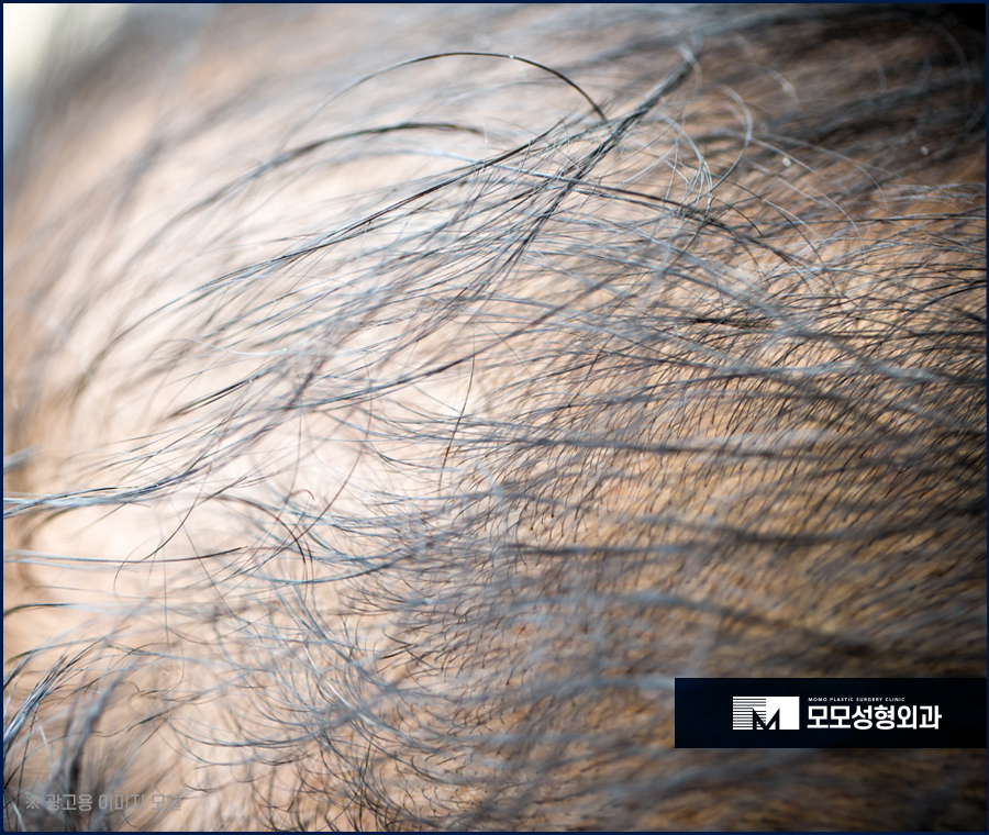모발이식회복기간 신속하게 이뤄지는 방향은 관련 이미지 4