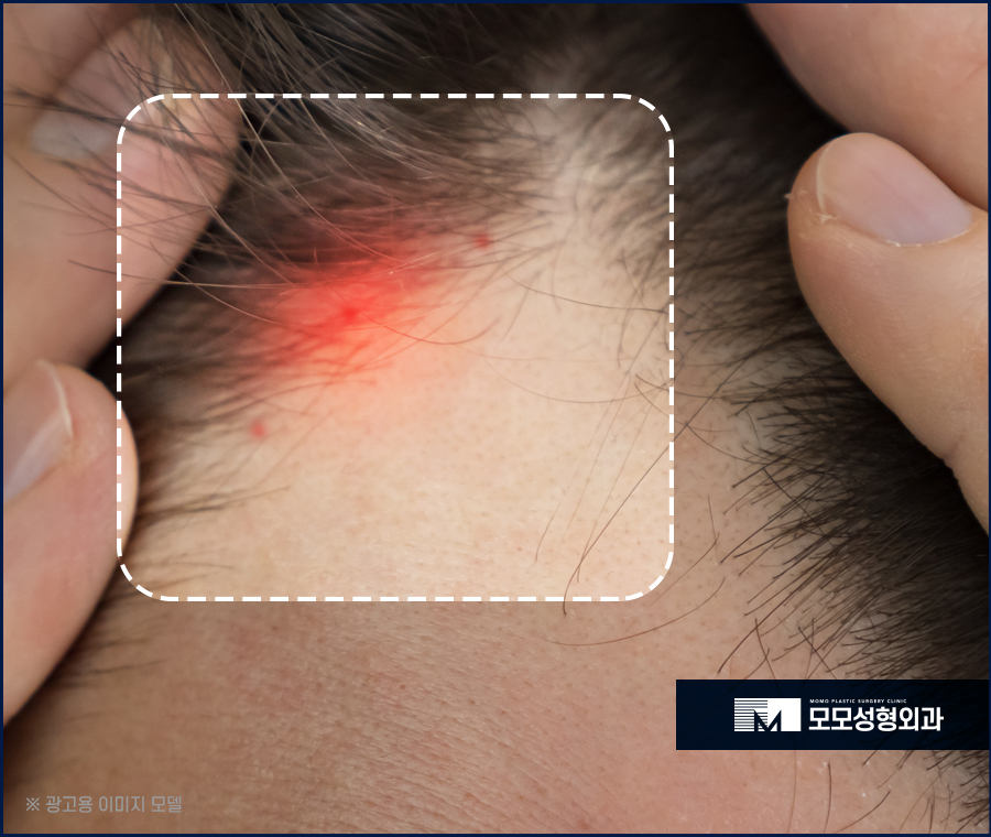 우습게 여기지 말아야 할 헤어라인 뾰루지 관련 이미지 4