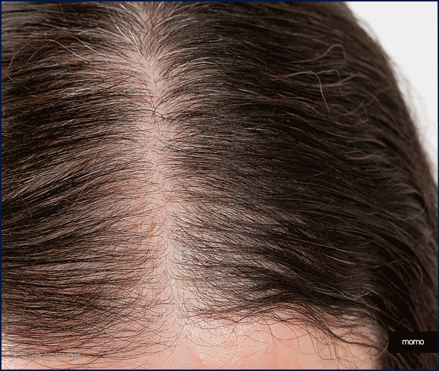 여자 가르마 탈모 모발이식으로 효과보려면? 관련 이미지 6