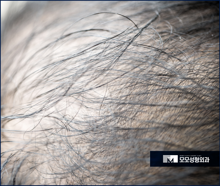 모발 얇아짐 심각성을 알고 경각심을 가져야만 관련 이미지 4