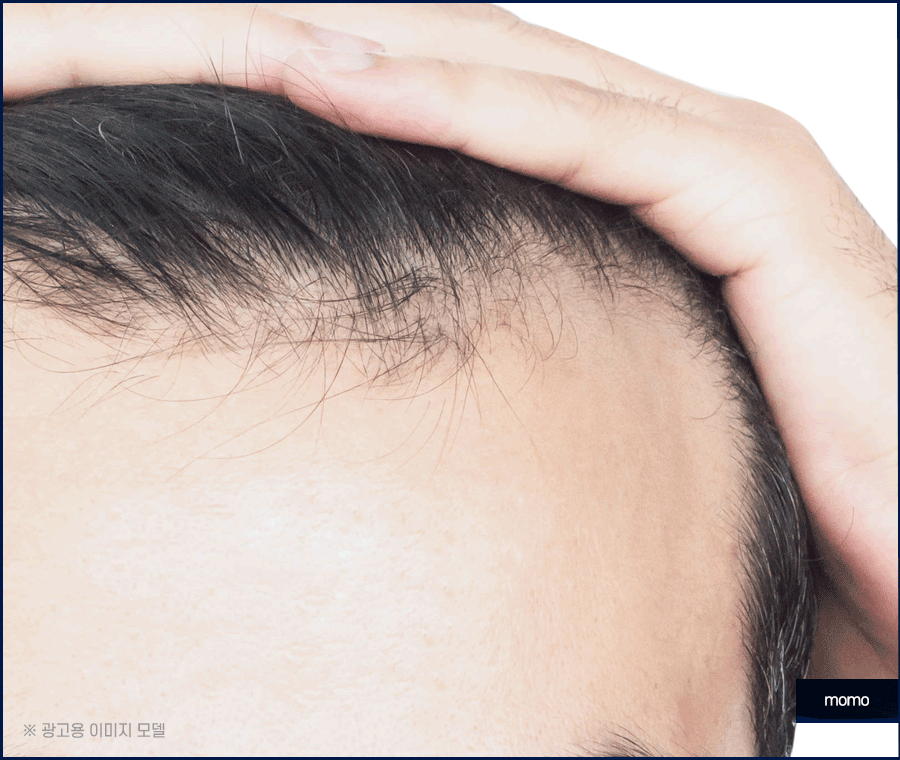 강남 탈모 병원 원인 파악부터 철저하게 시작하는 곳 관련 이미지 9