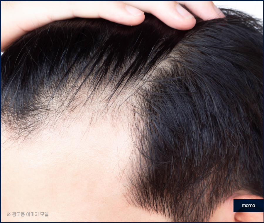엠자이마 고민 탈출을 위한 모발이식 관련 이미지 11