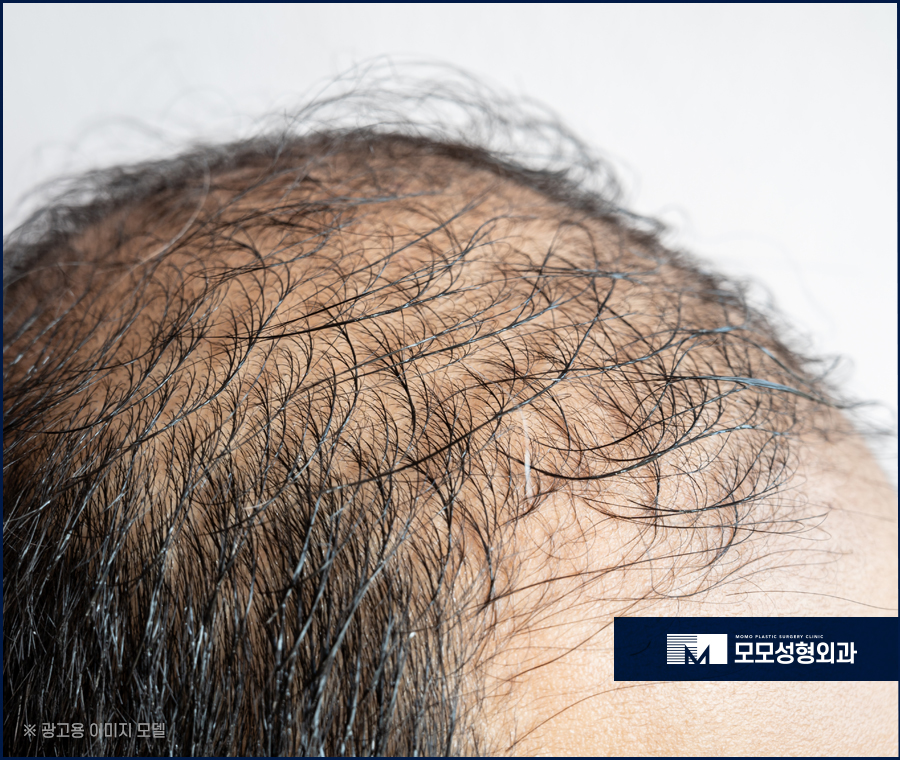 미녹시딜부작용 미리 알고 올바르게 관련 이미지 4