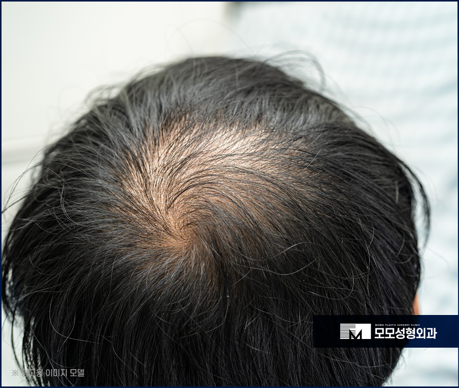 모발이식 2주 조심해야 할 부분과 관리 방법 관련 이미지 3