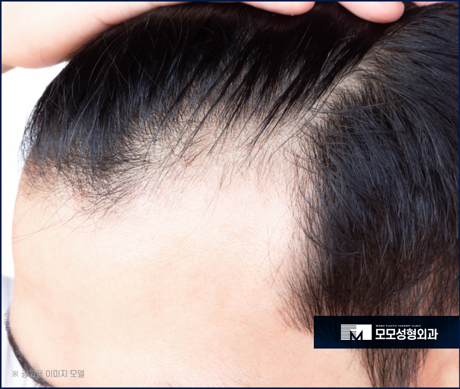 비절개모발이식통증 비교할 때 꼭 알아야 하는 점 관련 이미지 2