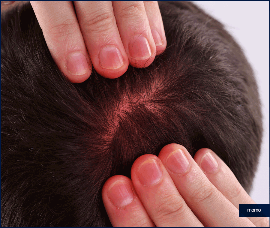 탈모 클리닉 비용의 기준이 되는 조건은? 관련 이미지 6