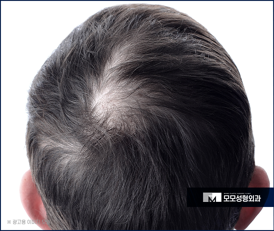 서울탈모병원추천 놀라운 변화로 나아가는 관련 이미지 3