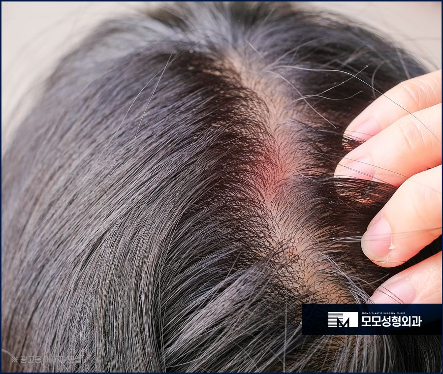 두피모낭염 증상 및 완화를 위한 방법에 대해서 관련 이미지 2