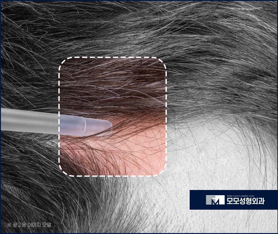 미녹시딜 5% 효과와 사용 전 알아두어야 할 점 관련 이미지 6