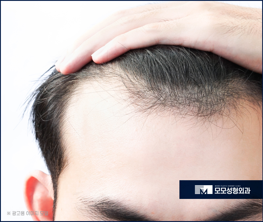 헤어라인모발이식부작용 조심하고 주의해야 할 점은 관련 이미지 3