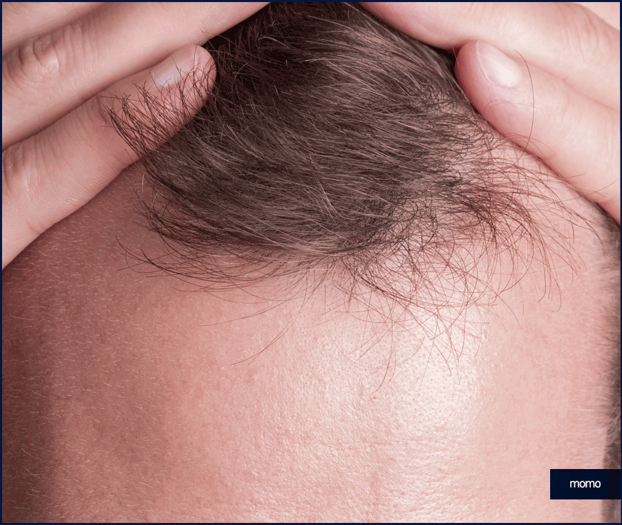 20대 모발이식 성공적인 결과를 위한 필수 조건 관련 이미지 10