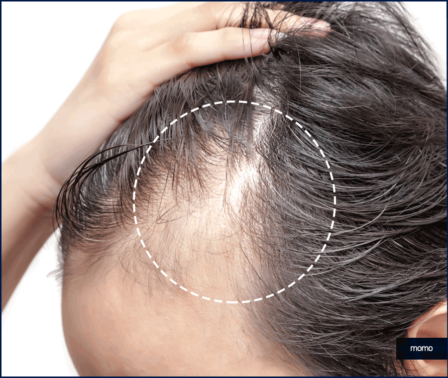 m자탈모병원 모발이식 고민이신 분들이라면 필독 관련 이미지 6